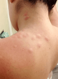 bedbug bites shoulders back