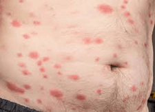 bed bug bite photo - belly