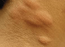 bed bug bite picture - neck