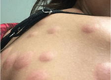 bed bug bite picture - back