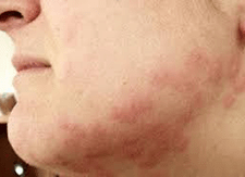 bed bug bite picture - face