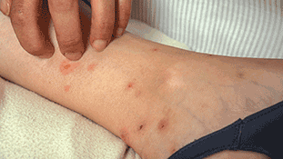 flea bites