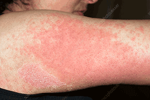rash from allergic reaction