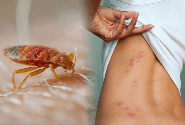 bed bug and their bites on a person's back