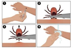 how to remove a tick