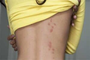 bed bug rash